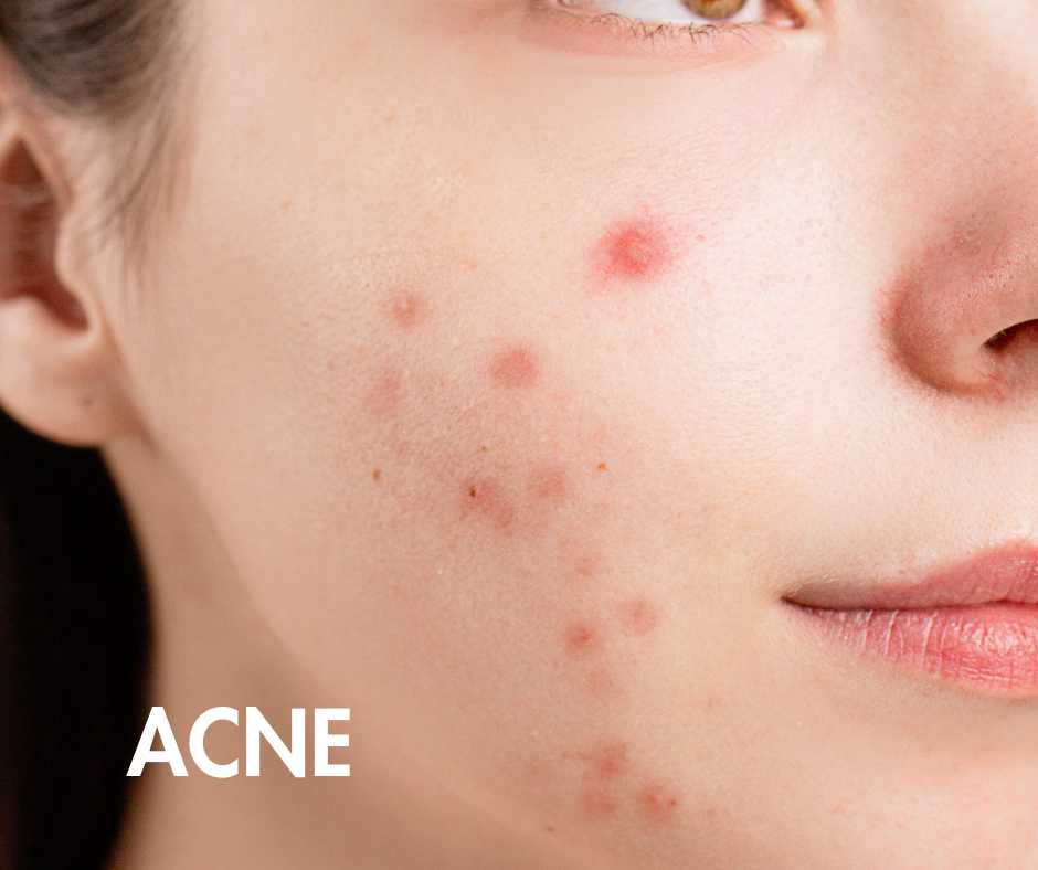 Acne
